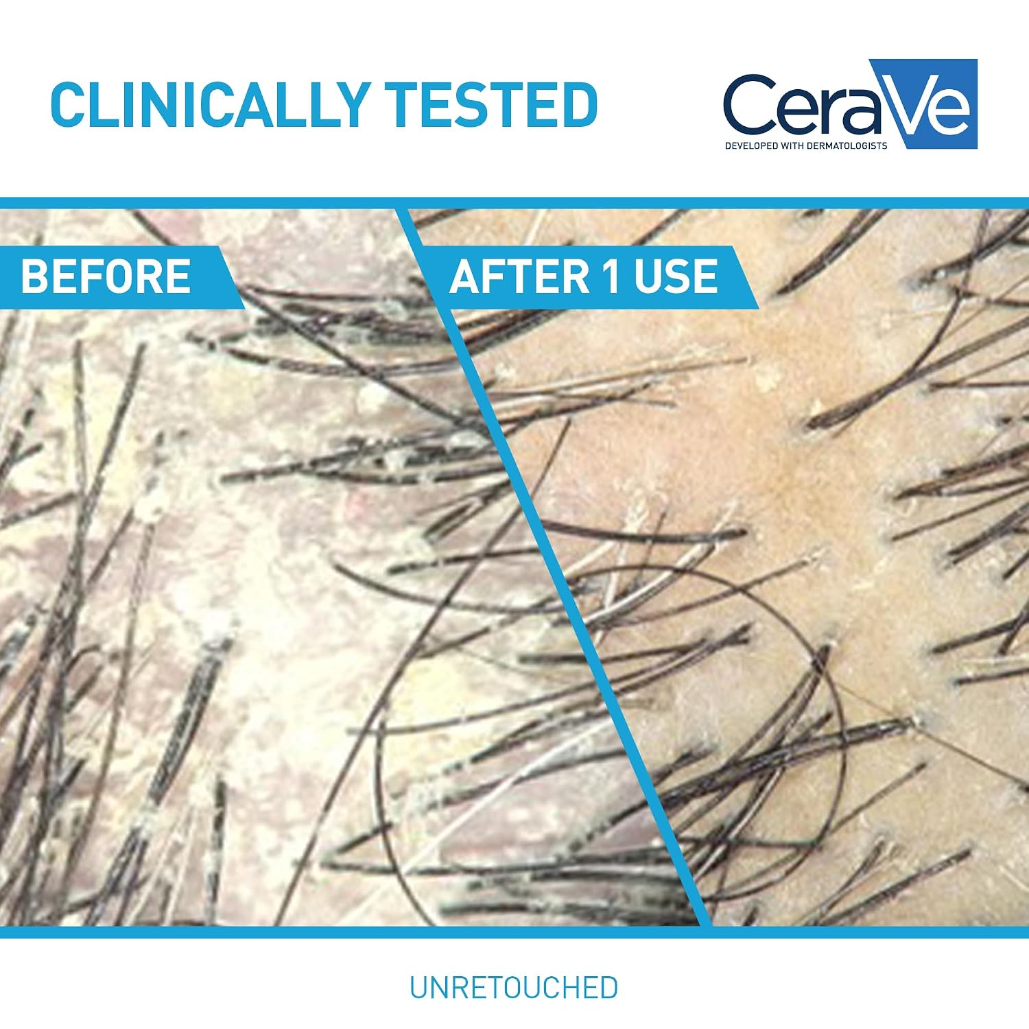 CeraVe 2 In 1 Hydrating Anti Dandruff Shampoo And Conditioner. 12 Fl Oz | 1% Pyrithione Zinc Dandruff Treatment Helps Eliminate Flakes and Relieve Itchy Scalp In A Sulfate-Free. Color-Safe Formula